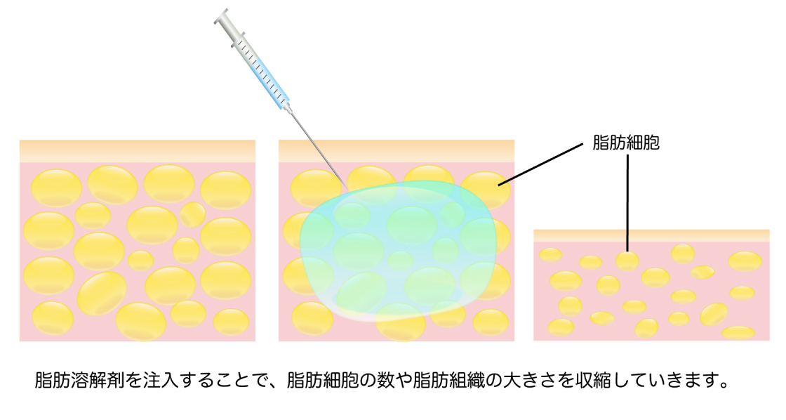 脂肪溶解注射の図解